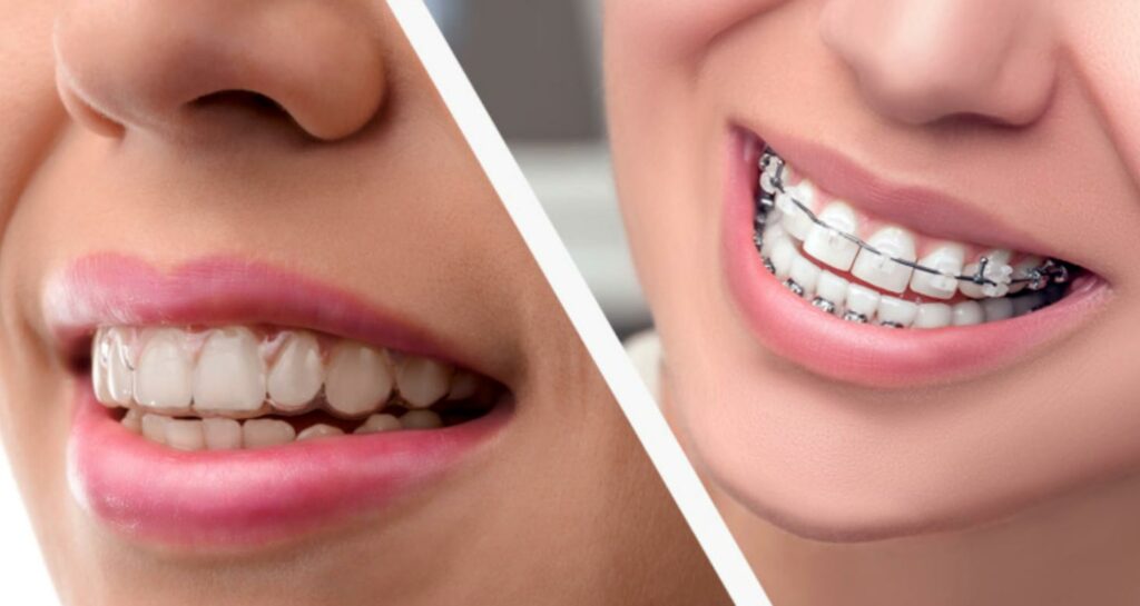 Teeth Alignment